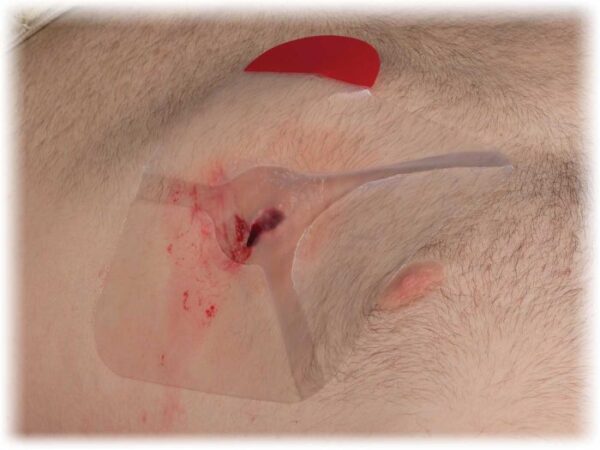 Hyfin Vent Chest Seals - 2 Pack - Image 5